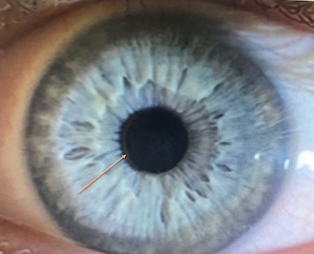 Iridology Iris